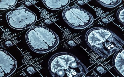 Are Strokes On The Rise For Younger Adults, As Compared To Their Older Peers?
