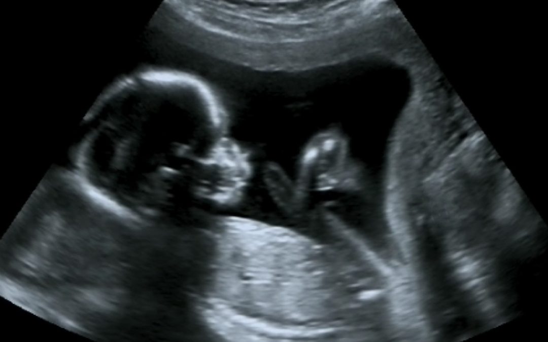 sonogram and possible birth injury