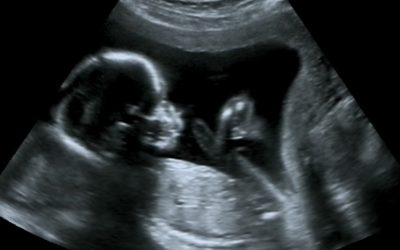 Impact Of Covid-19 On Birth Injury And Medical Malpractice Cases
