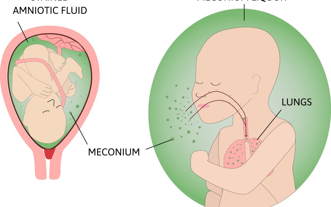 Meconium Aspiration Syndrome and HIE