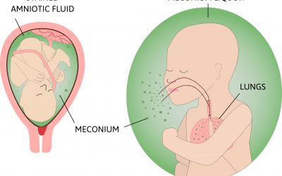 Meconium Aspiration Syndrome And HIE In Babies