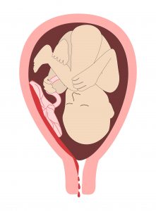 Detached Placenta