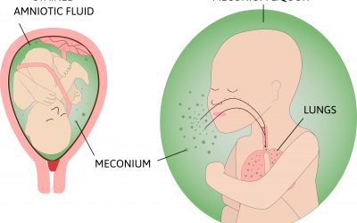 Can Meconium Cause A Traumatic Brain Injury (HIE)?