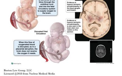 Watching A Baby’s Oxygen Levels And HIE