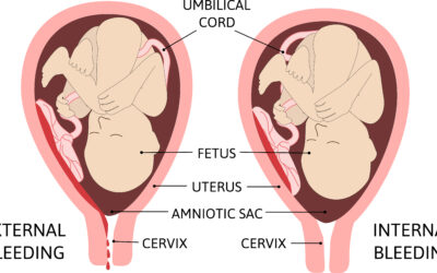 An HIE Birth Injury With A Uterine Rupture