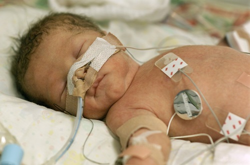 Baby’s Life Expectancy With An HIE Brain Injury