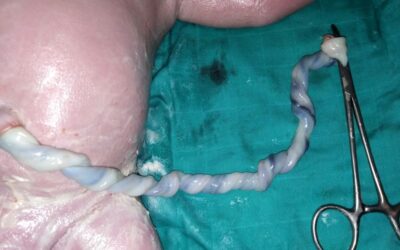 Why Does Your Baby’s Umbilical Cord Gas Matter?