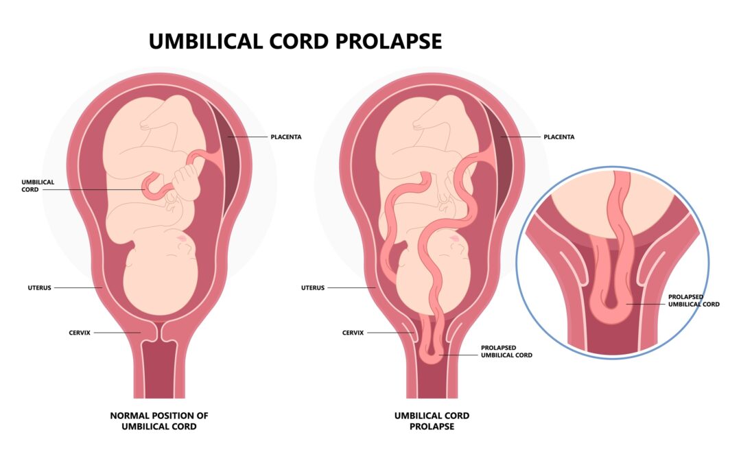 Surviving umbilical cord prolapse and HIE