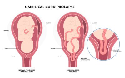 Surviving Umbilical Cord Prolapse And HIE
