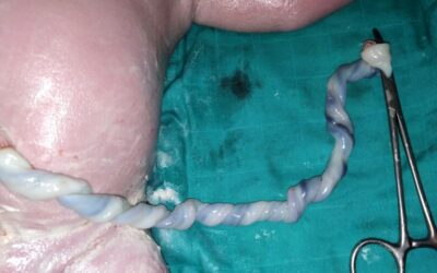 Can The Umbilical Cord Around The Neck Cause A Brain Injury?