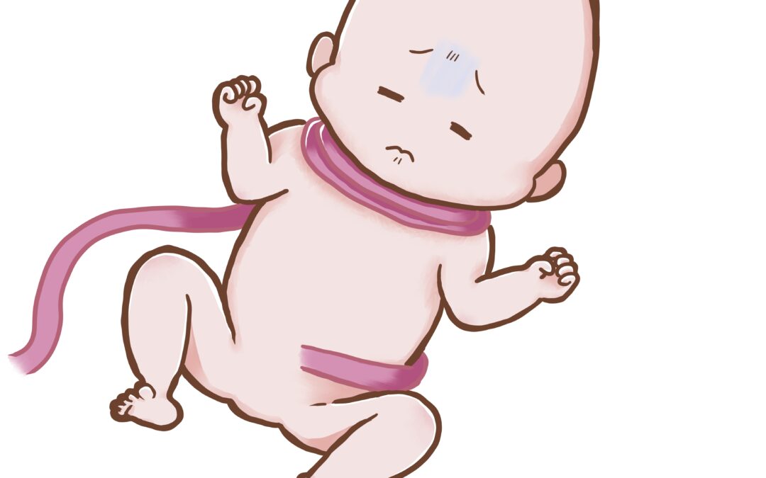 Understanding umbilical cord around your baby’s neck and HIE